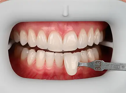 after: Teeth whitening