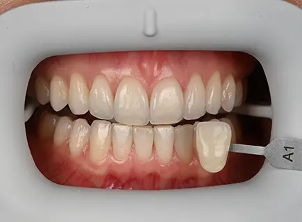 before: Teeth whitening