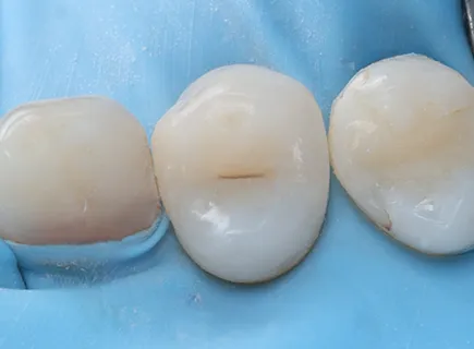 after: Hidden caries treatment