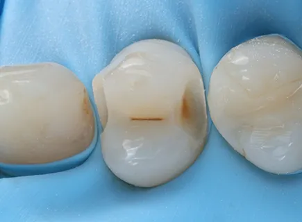 before: Hidden caries treatment
