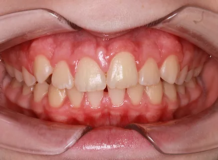 after: Orthodontic treatment