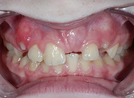 before: Orthodontic treatment