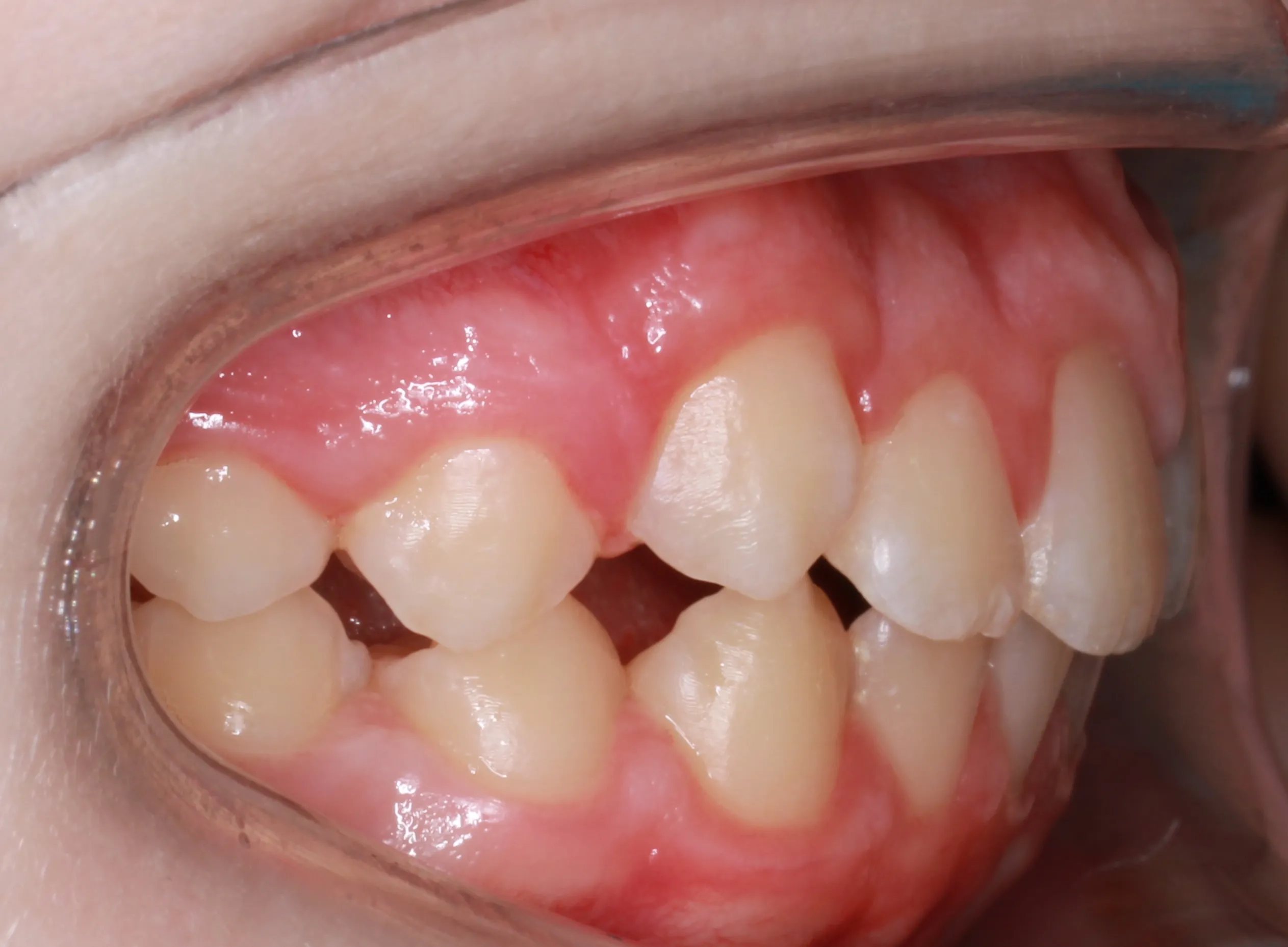 after: Orthodontic treatment