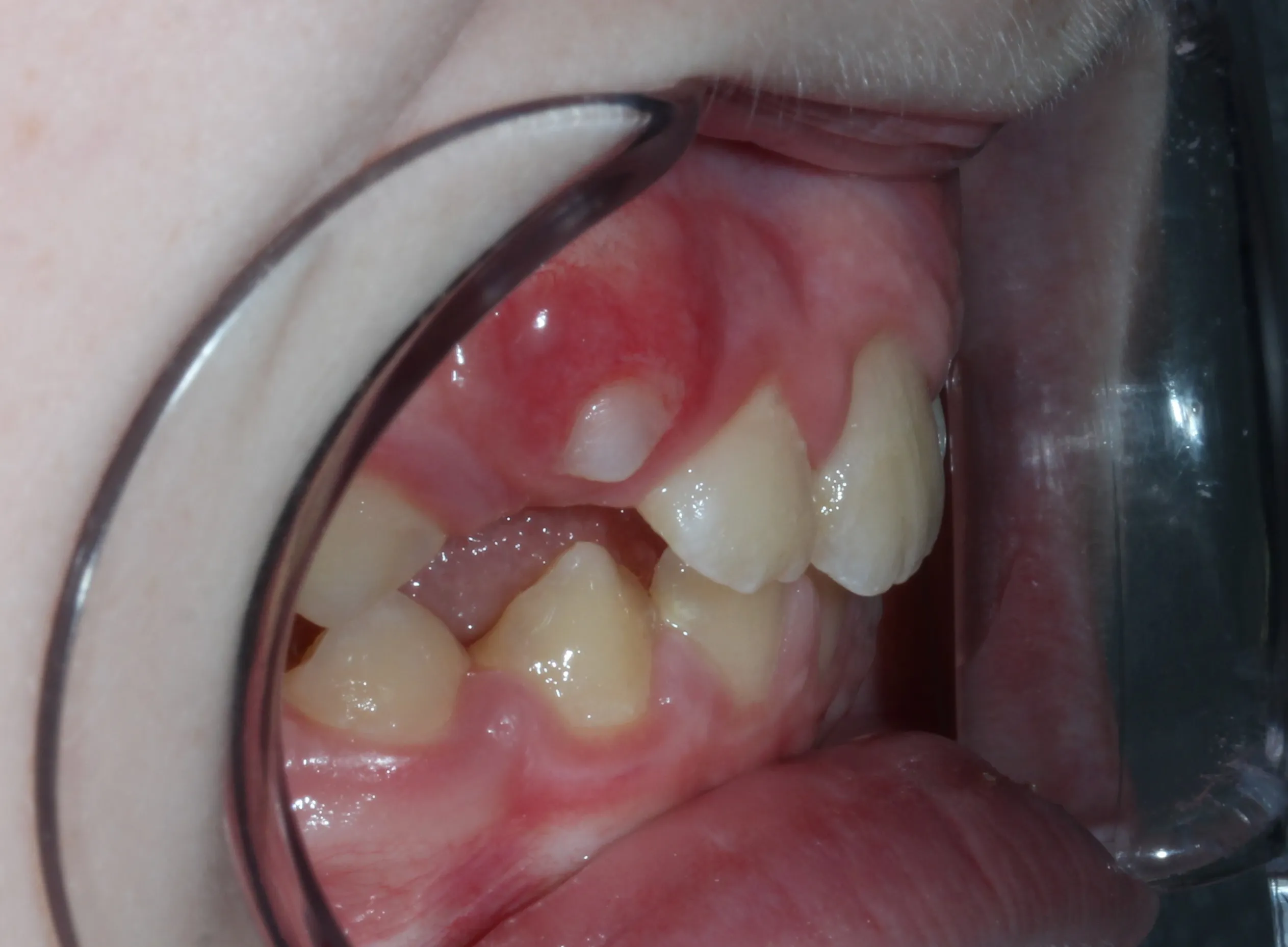 before: Orthodontic treatment
