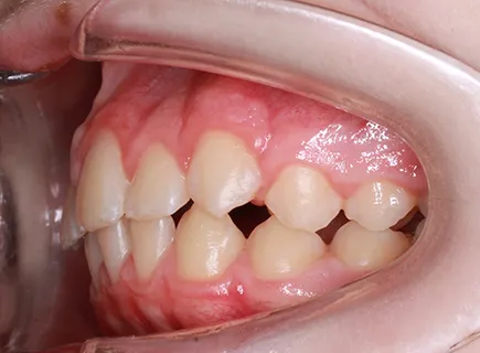 after: Orthodontic treatment