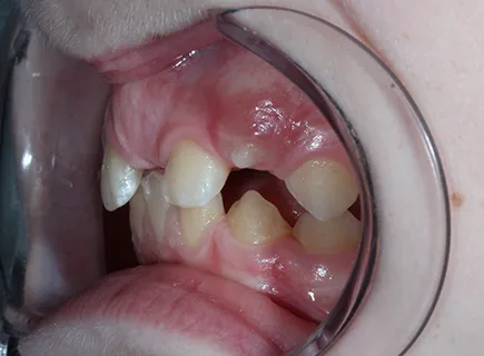 before: Orthodontic treatment