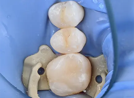 after: Composite filling