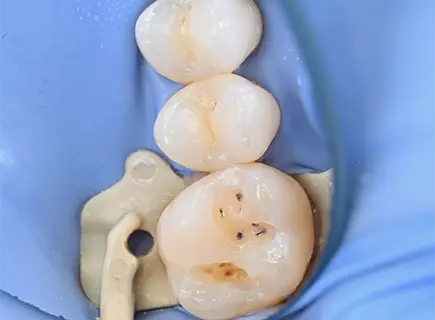 before: Composite filling