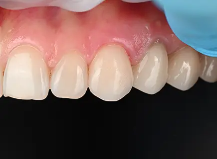 after: Porcelain veneers