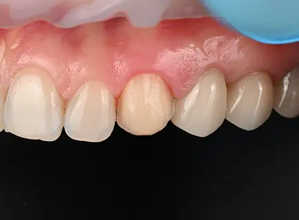 before: Porcelain veneers