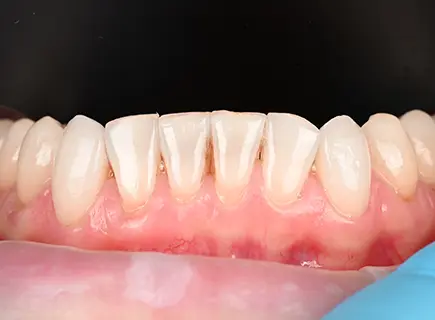 after: Porcelain veneers