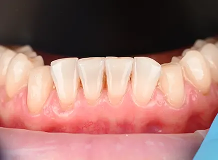 before: Porcelain veneers