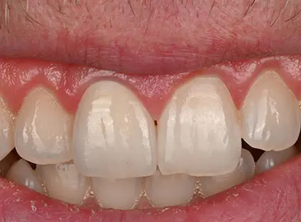 after: Single ceramic crown
