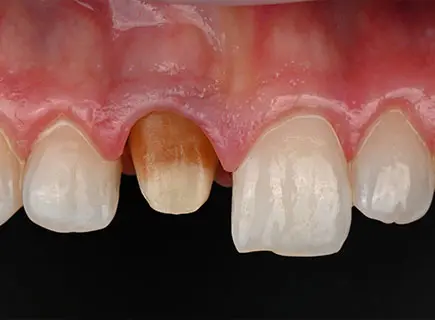 before: Single ceramic crown