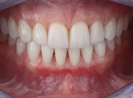 after: Porcelain veneers