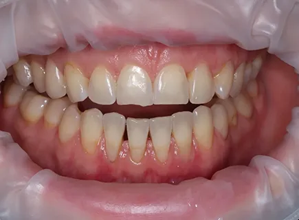 before: Porcelain veneers