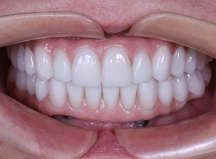after: Full arch implant treatment