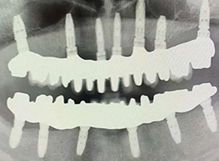 before: Full arch implant treatment