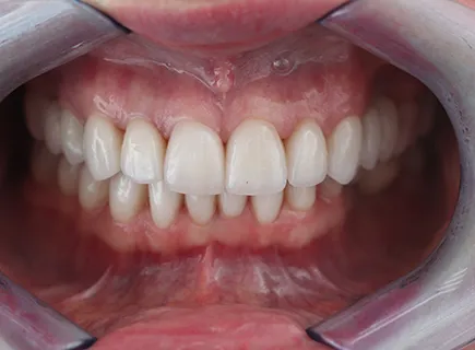 after: Full-mouth reconstruction