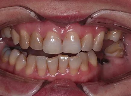 before: Full-mouth reconstruction