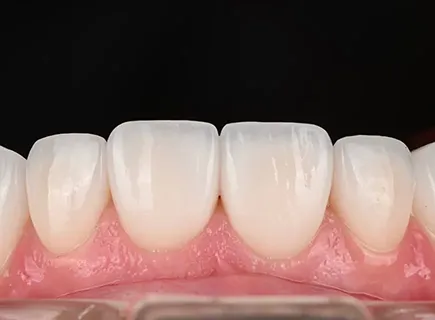 Full-Mouth Rehabilitation and Aesthetic Veneers